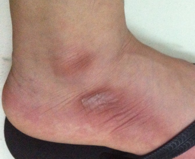 脚踝处的皮肤这是什么?