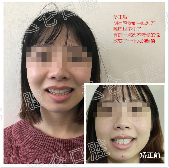 案例二:牙齿反颌,咬合关系不正确