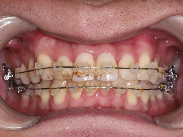 错位牙回归正确轨道,整牙不恐怖,选对杭州牙科医院最关键